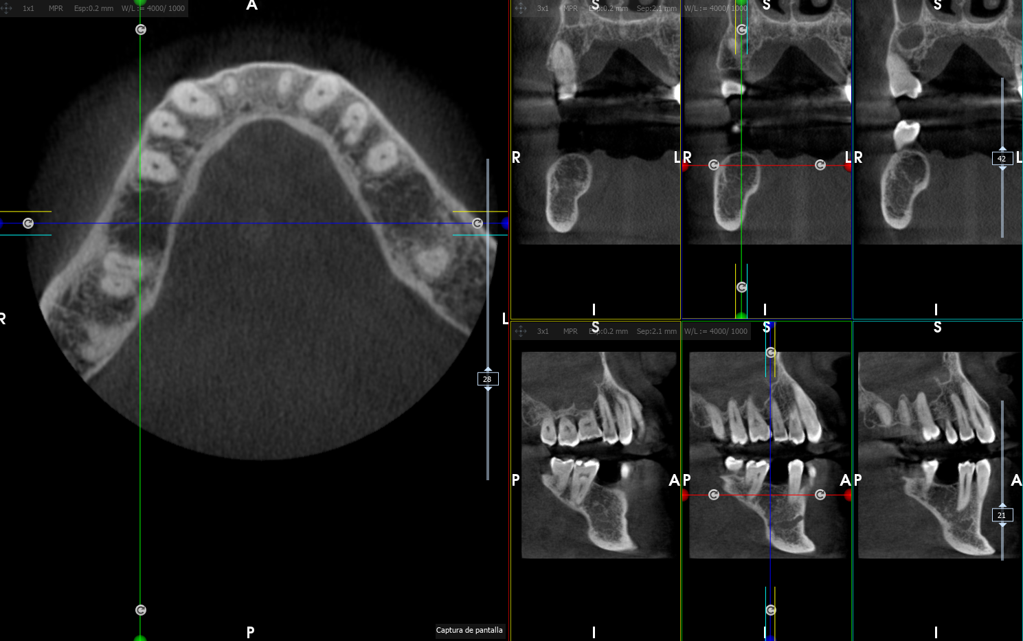 TAC dental en Argés Toledo - Clínica Hervás Odontología